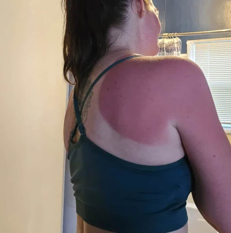 Sunburned shoulder from sun exposure, with a tattoo visible on the upper back.